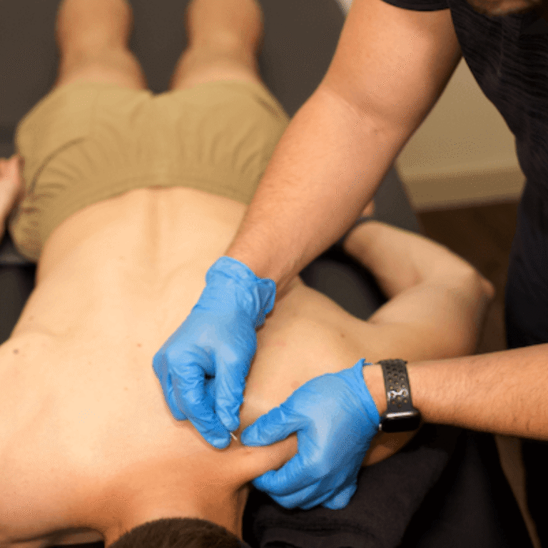 Dry needling treatment at Voltex Physical Therapy in Austin